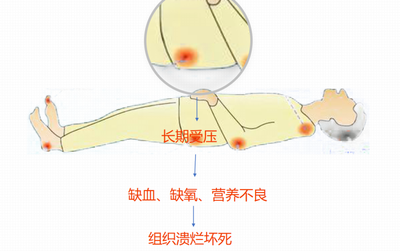 多功能护理床——卧床病人的贴心护士