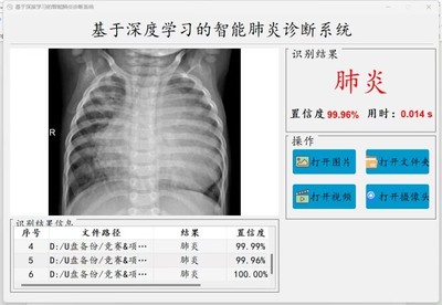 基于深度学习的智能肺炎诊断系统